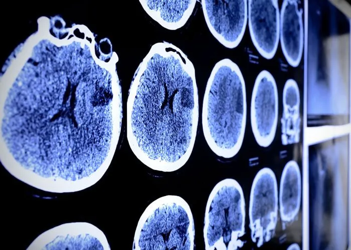 Brain Injury VA Disability Lawyers Kalamazoo, MI